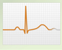 Electrocardiogram - ECG - what the tracing tells your doctor