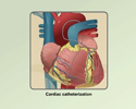 Cardiac catheterization - uses in diagnosis, evaluation and treatment