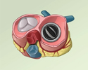 Heart valve replacement - overview