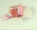 Central sleep apnea (CSA)