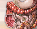 Colon cancer