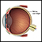 Retinal detachment repair - normal anatomy