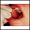 Lichen planus on the oral mucosa