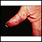 Dermatitis herpetiformis on the thumb