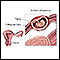 Ectopic pregnancy